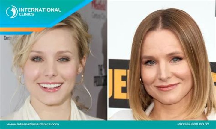 Kristen Bell Plastic Surgery Before and After