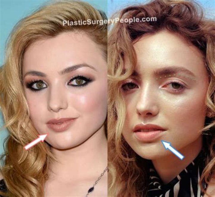 Peyton List Plastic Surgery Before and After